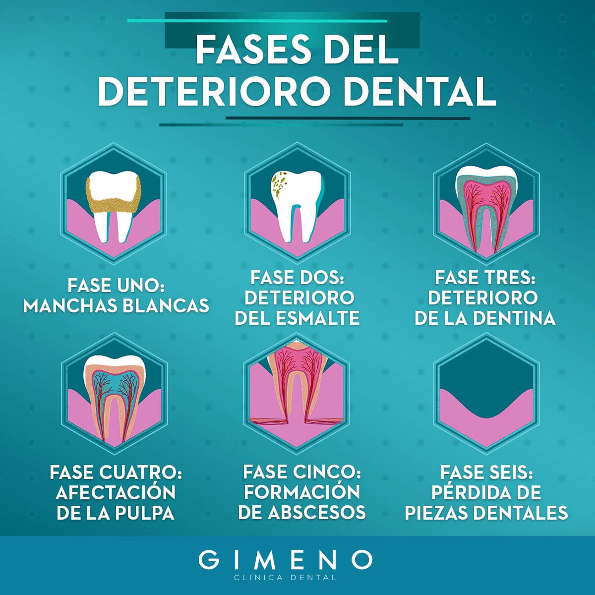 Las 6 Fases De Cómo Se Producen Las Caries Clínica Gimeno 2830